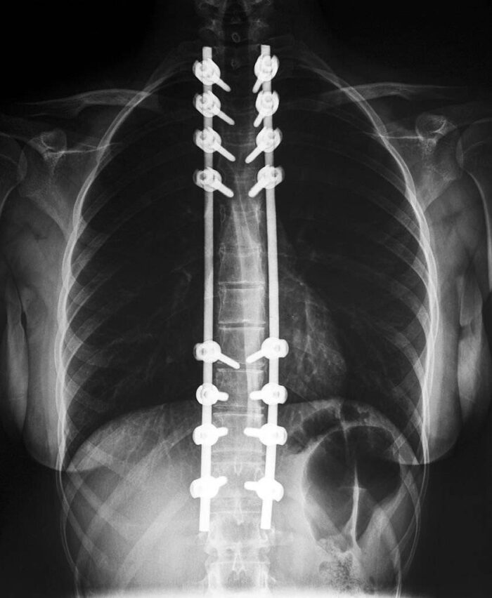 Spinal Implants